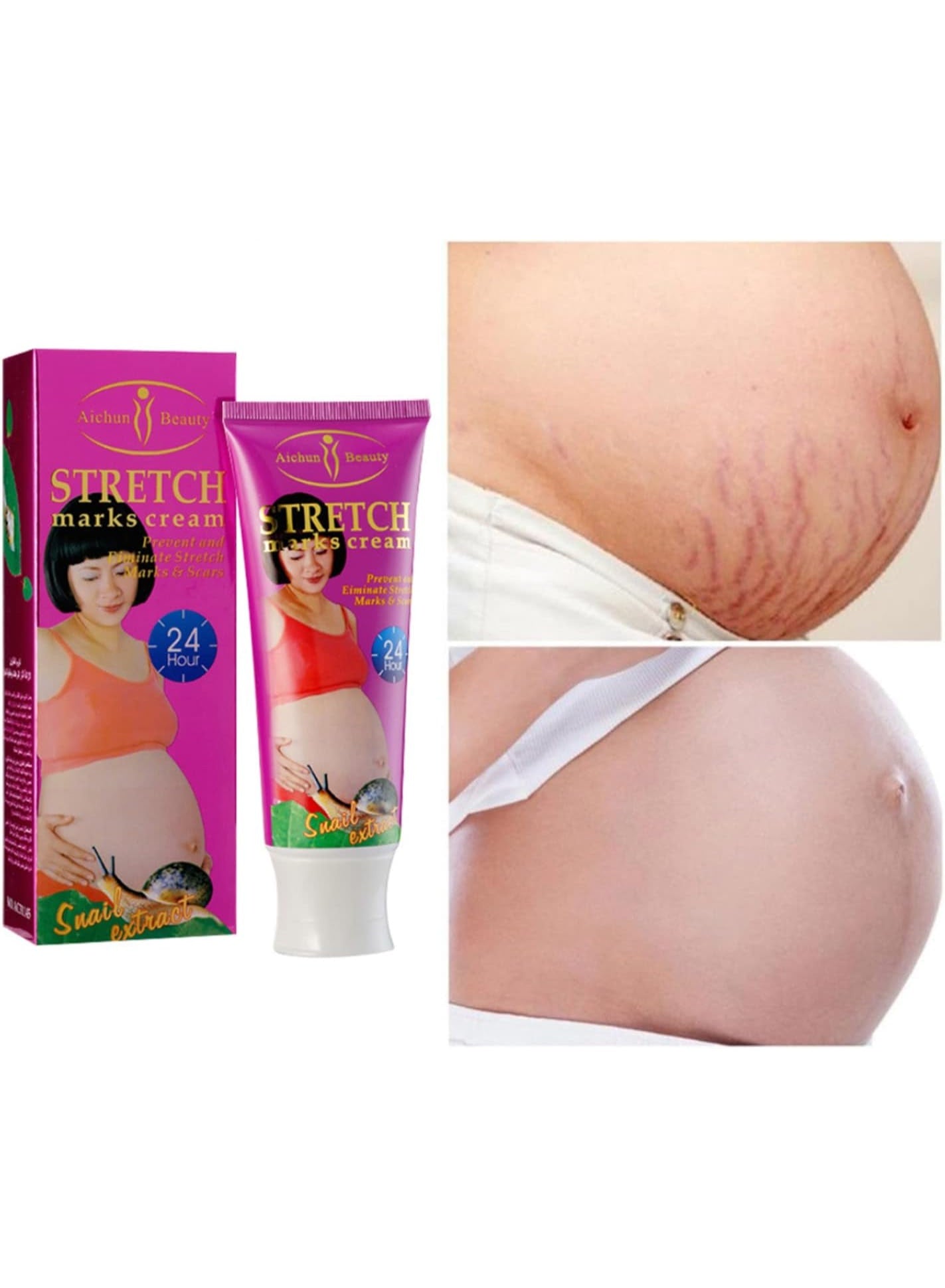 aichun beauty, cells 120g, cream snail, damaged skin, extract reduce, marks cream, marks cream snail, reduce skin, remove damaged, scars remove, skin cells, skin cells 120g, skin scars, snail extract, stretch marks